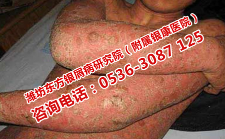哪个医院治疗牛皮癣可以