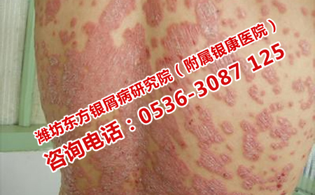 为什么要去正规医院治疗牛皮癣