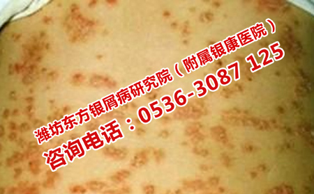 治疗牛皮癣过程中要注意什么问题