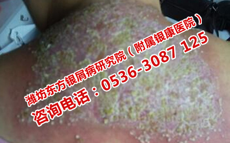 牛皮癣患者怎样调节自己的病情