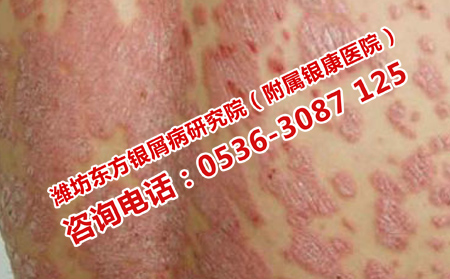 初次发病的牛皮癣怎么治疗