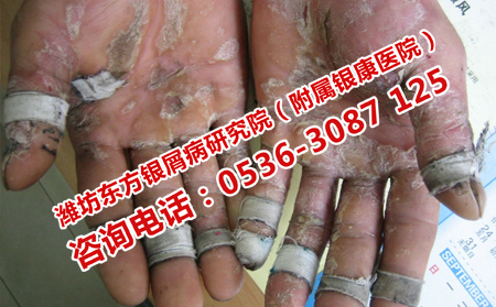 潍坊专门治疗银屑病的医院