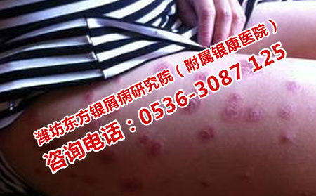 预防牛皮癣复发的方法
