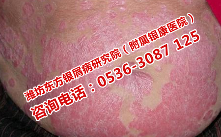 潍坊皮肤病医院提醒注意治疗牛皮癣的问题