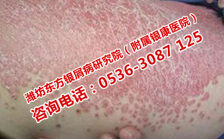 牛皮癣怎样就治治治疗效果果果可以了呢