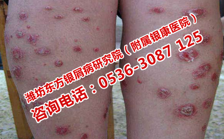 如何对牛皮癣进行对症医治呢