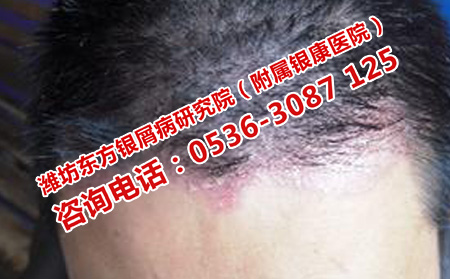 银屑病为什么不能喝茶