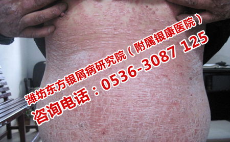 治疗皮肤病注意的问题
