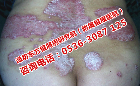 对牛皮癣患者有害的治疗