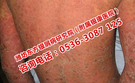 预防牛皮癣并发症的危害
