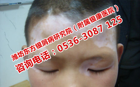白癜风的发病因素有