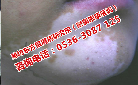 如何有效治疗白癜风疾病