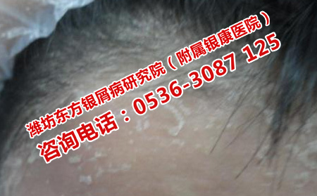 安丘皮肤病医院治疗牛皮癣