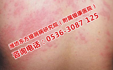 潍坊专门治疗荨麻疹的医院
