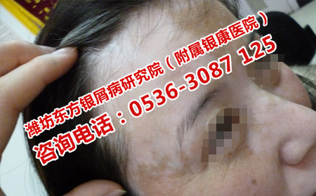 潍坊哪家医院治白癜风可以