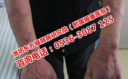 治疗胳膊牛皮癣的皮肤病医院