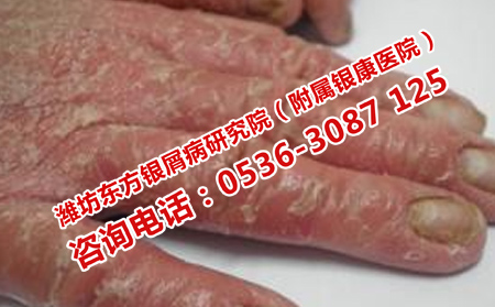 初发的牛皮癣症状