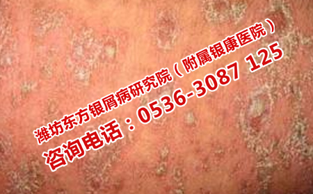 潍坊哪家医院看皮肤病可以