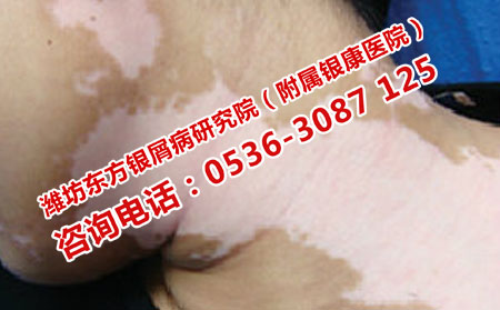 潍坊皮肤病医院治疗白癜风