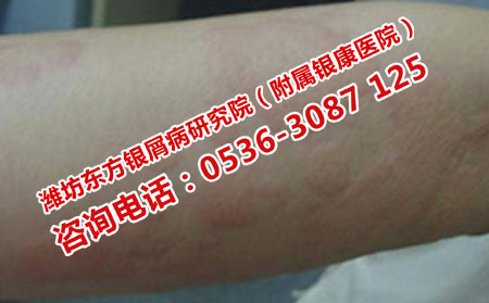 潍坊哪里治疗荨麻疹