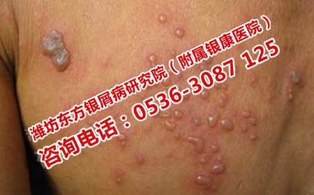 潍坊皮肤病医院护理疱疹