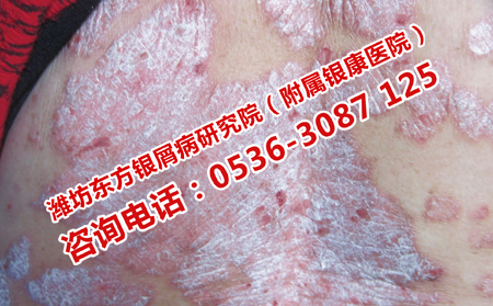 专门治牛皮癣的皮肤病医院