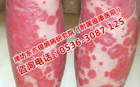 潍城区治疗银屑病费用