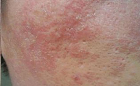 潍坊皮肤病防治所如何