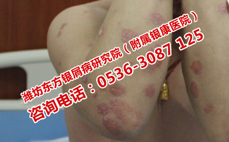维A酸治疗牛皮癣