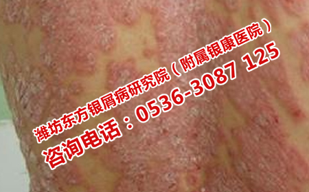如何消除寻常性银屑病