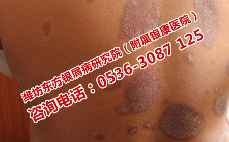 潍坊皮肤病医院可以吗