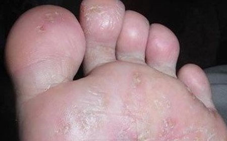 手足癣治疗办法