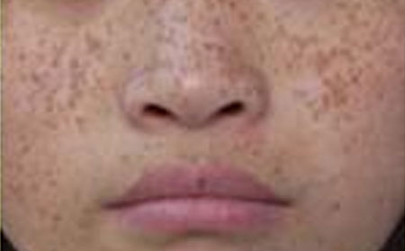 区分雀斑和黄褐斑