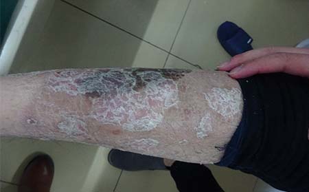 牛皮癣为什么会使患者脱屑