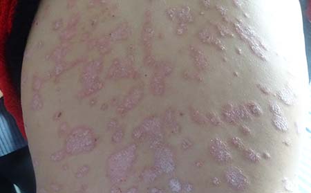 牛皮癣患者如何适当饮水