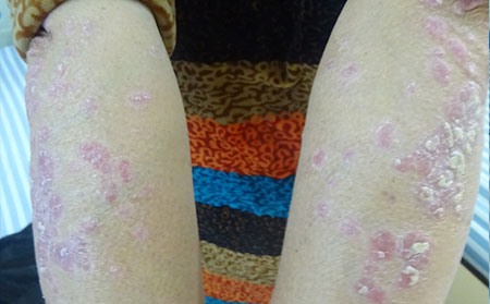 不建议牛皮癣患者做的几件事