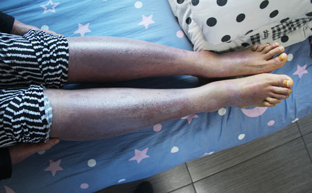 睡眠不足会影响牛皮癣的治疗吗