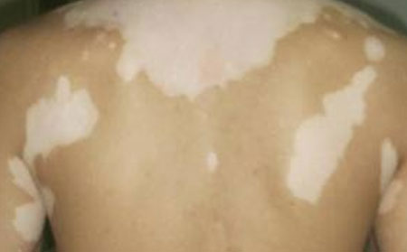 泛发型的白癜风如何进行预防