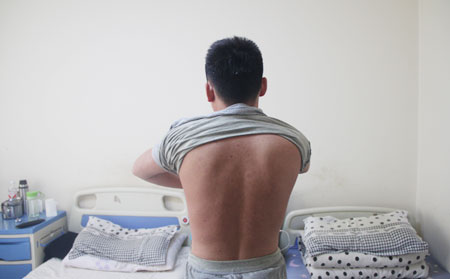 后天性的牛皮癣遗传吗