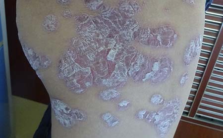 疤痕会导致牛皮癣复发吗