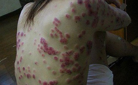 治疗牛皮癣难度大的原因