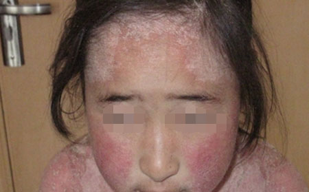 女性身上的牛皮癣要怎么进行治疗