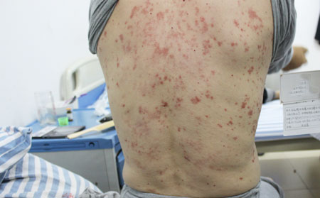 银屑病需要注意什么