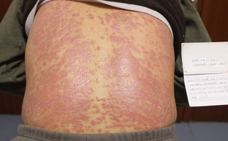 辨别银屑病的方法