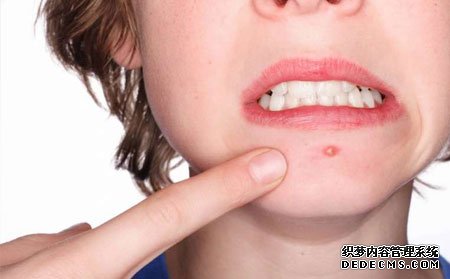 怎么治疗痘痘可以