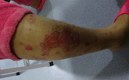 儿童银屑病怎样治疗