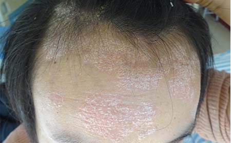 头部牛皮癣的特征是什么