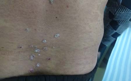 成人银屑病的有哪些症状特点