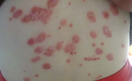 病情严重时银屑病会引起哪些并发症呢