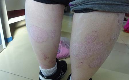 银屑病的病因特点是什么你了解吗